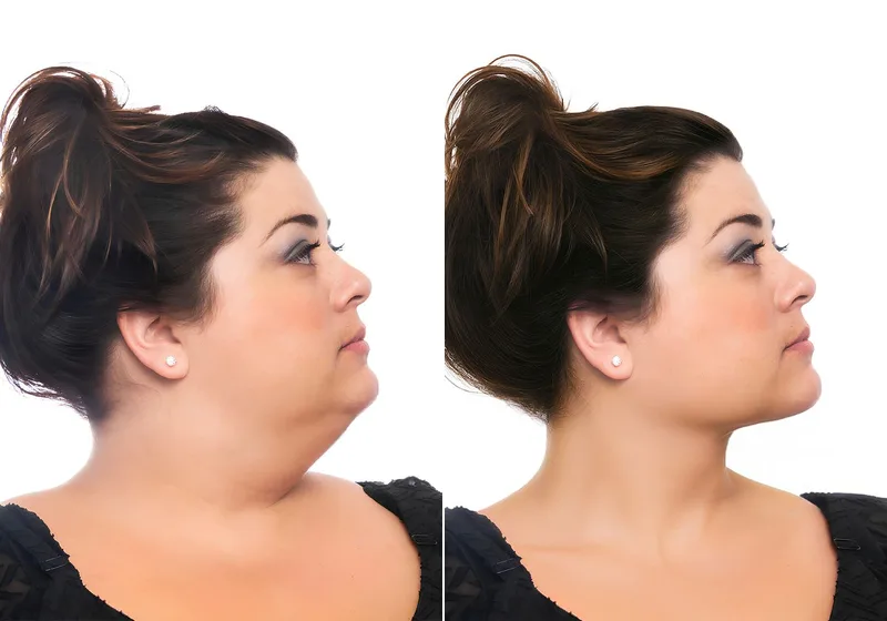 Double chin removal: before (left) and after (right)