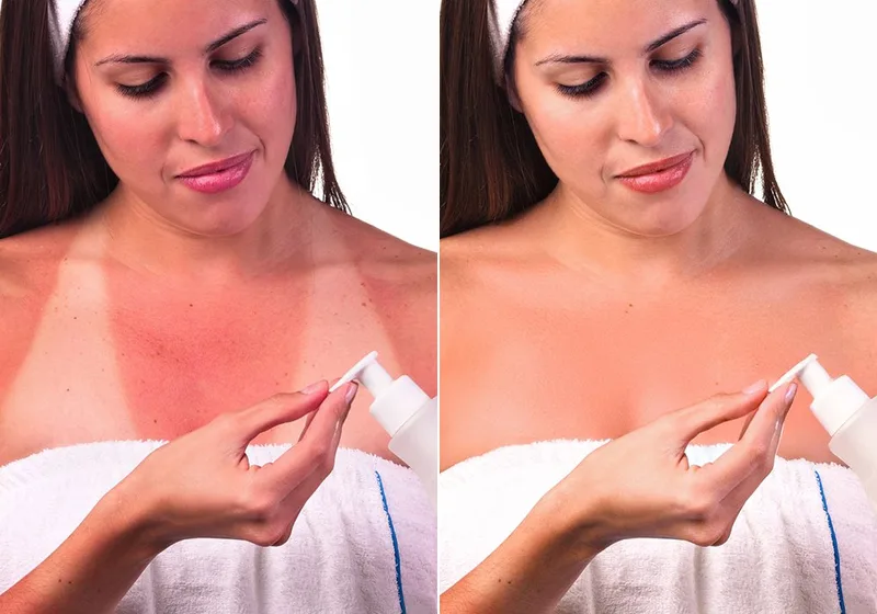 Sunburn & Tan Lines: before (left) and after (right)