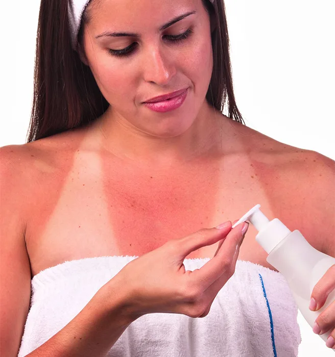 Sunburn & Tan Lines before retouching